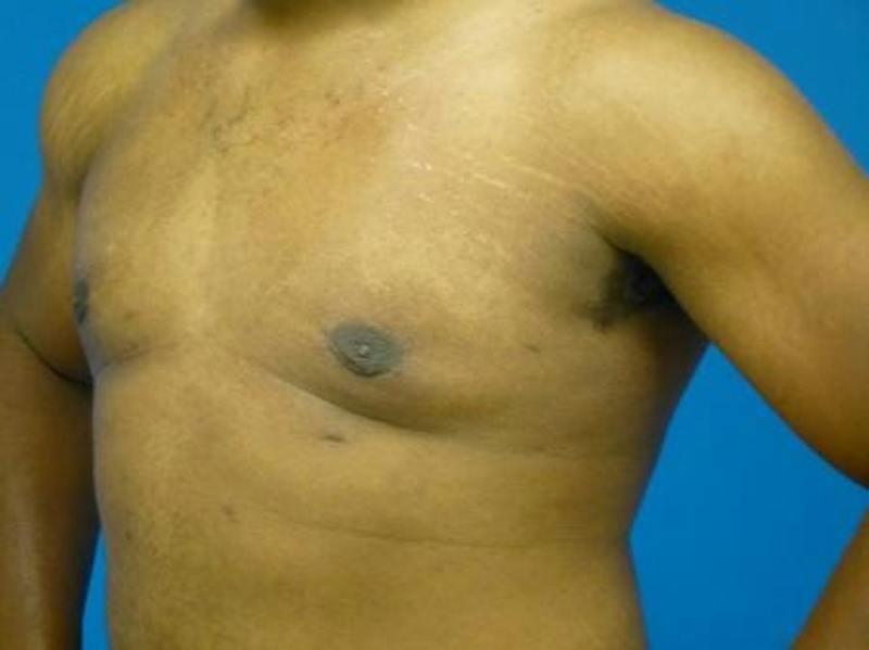Gynecomastia Before & After Gallery - Patient 223897 - Image 4