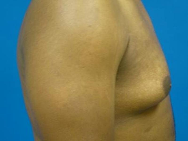 Gynecomastia Before & After Gallery - Patient 223897 - Image 5