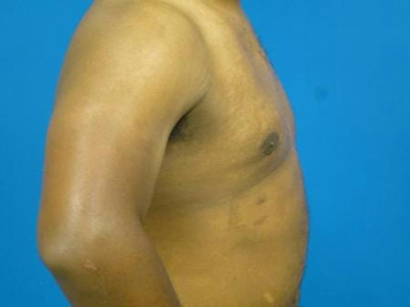 Gynecomastia Before & After Gallery - Patient 223897 - Image 6