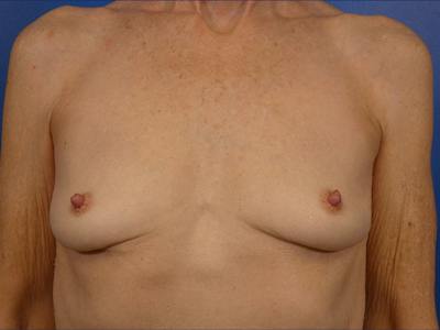 Breast Implant Removal Before & After Gallery - Patient 288853 - Image 2