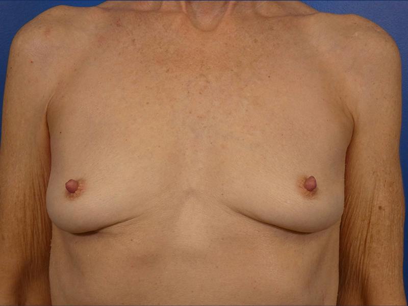 Breast Implant Removal Before & After Gallery - Patient 288853 - Image 2