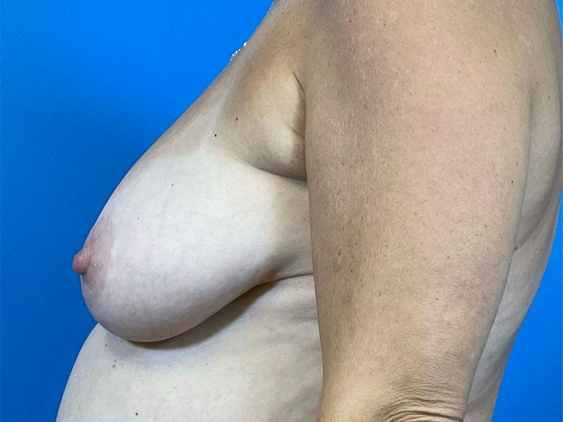 Fat Grafting Before & After Gallery - Patient 108786 - Image 1
