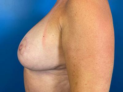 Fat Grafting Before & After Gallery - Patient 108786 - Image 2