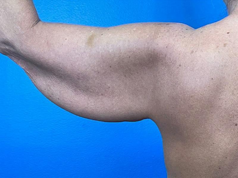 Brachioplasty Before & After Gallery - Patient 379064 - Image 1