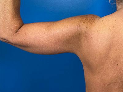 Brachioplasty Before & After Gallery - Patient 379064 - Image 2