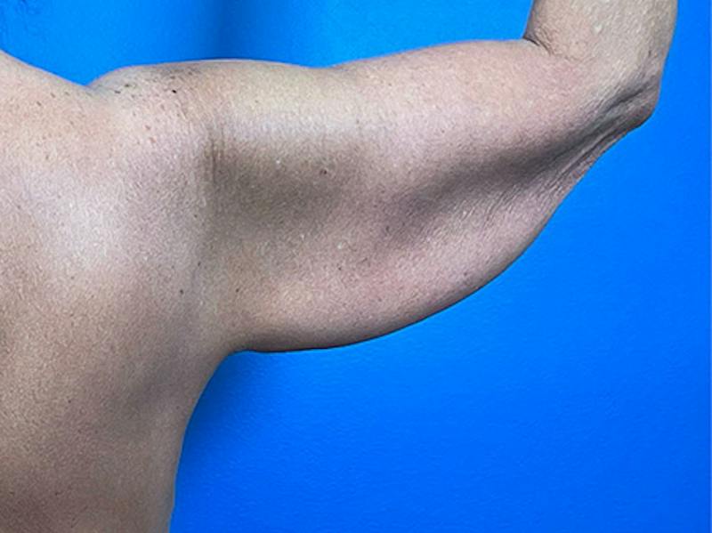 Brachioplasty Before & After Gallery - Patient 379064 - Image 3