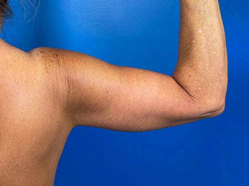 Brachioplasty Before & After Gallery - Patient 379064 - Image 4