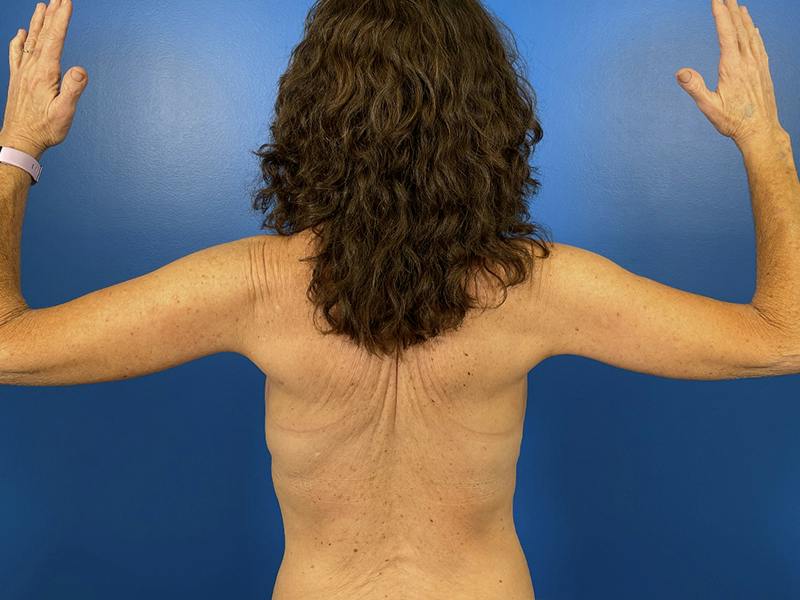 Brachioplasty Before & After Gallery - Patient 344628 - Image 2