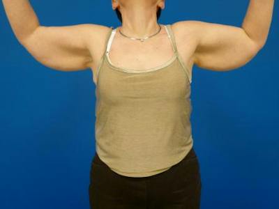 Brachioplasty Before & After Gallery - Patient 131149 - Image 1