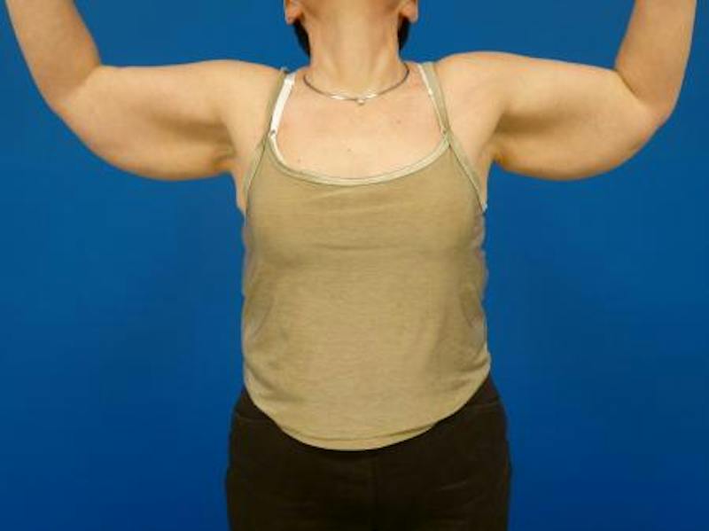 Brachioplasty Before & After Gallery - Patient 131149 - Image 1