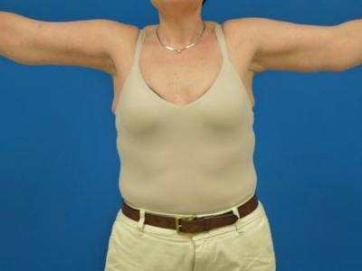 Brachioplasty Before & After Gallery - Patient 131149 - Image 2