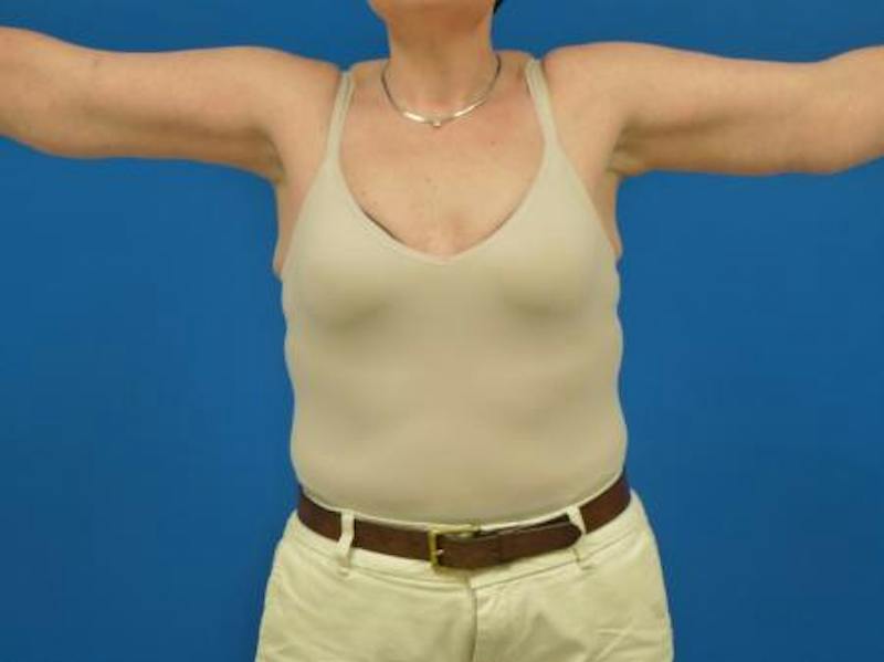 Brachioplasty Before & After Gallery - Patient 131149 - Image 2