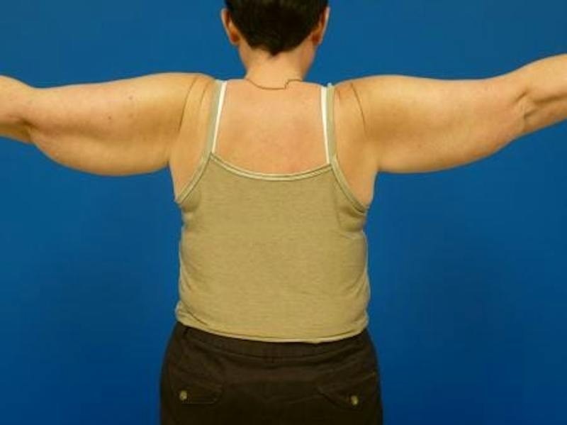 Brachioplasty Before & After Gallery - Patient 131149 - Image 3