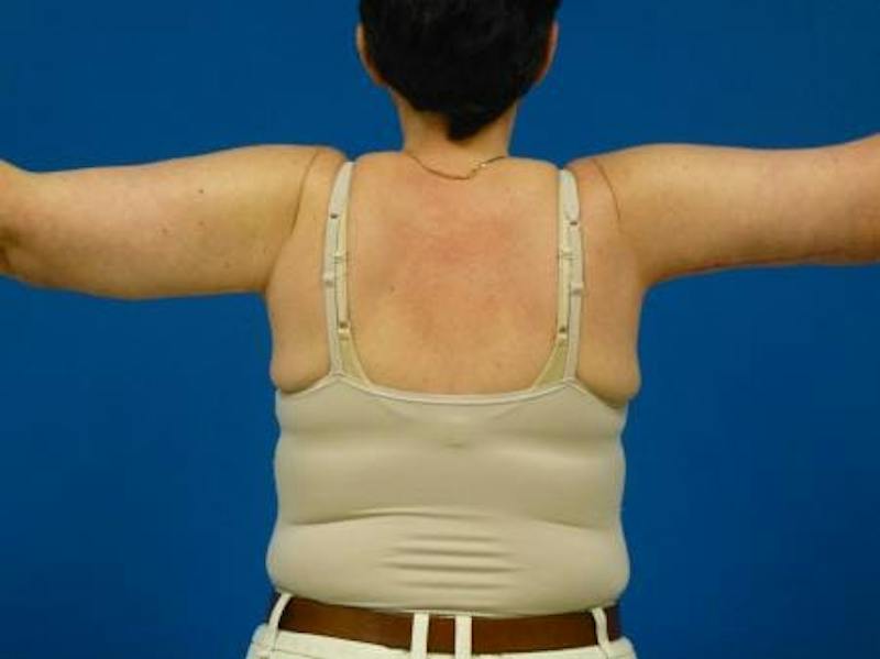 Brachioplasty Before & After Gallery - Patient 131149 - Image 4