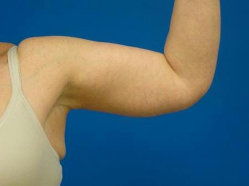 Brachioplasty Before & After Gallery - Patient 131149 - Image 6