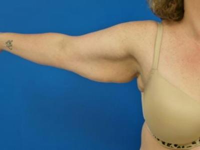 Brachioplasty Before & After Gallery - Patient 160325 - Image 1