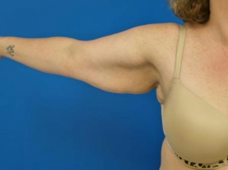 Brachioplasty Before & After Gallery - Patient 160325 - Image 1