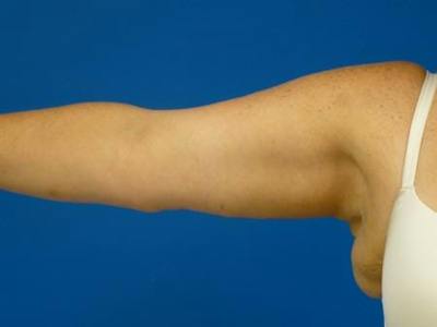 Brachioplasty Before & After Gallery - Patient 160325 - Image 2