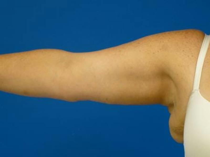 Brachioplasty Before & After Gallery - Patient 160325 - Image 2