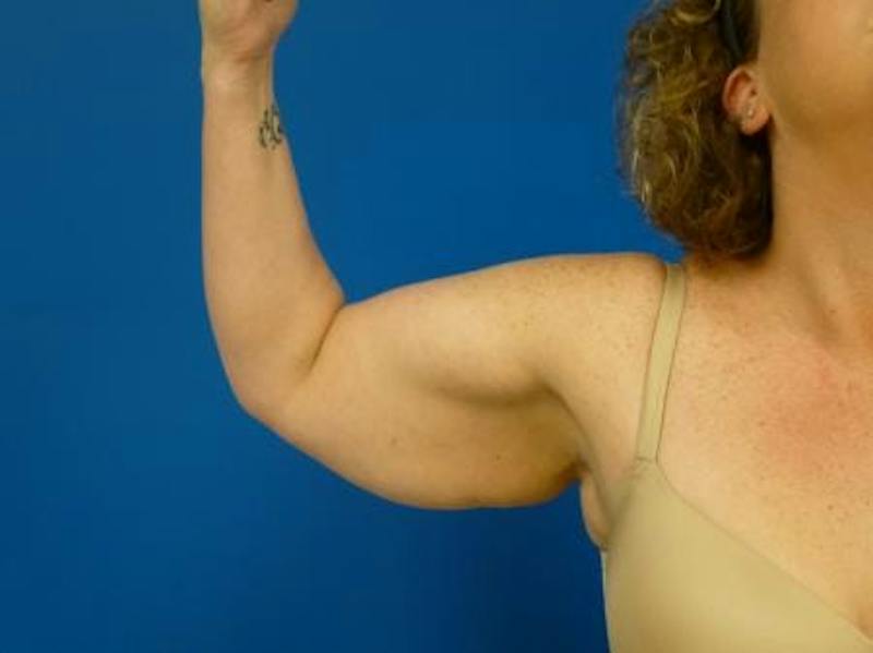Brachioplasty Before & After Gallery - Patient 160325 - Image 3