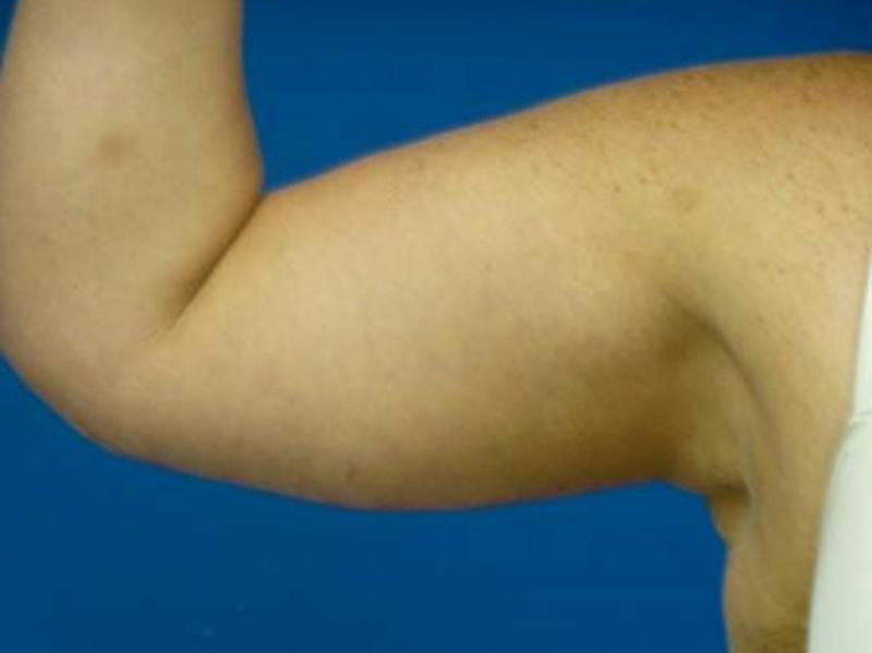 Brachioplasty Before & After Gallery - Patient 160325 - Image 4