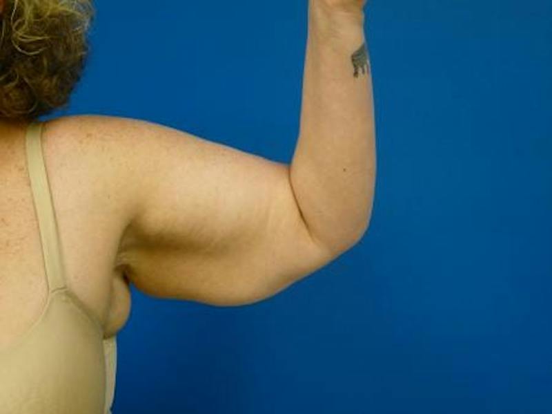 Brachioplasty Before & After Gallery - Patient 160325 - Image 5
