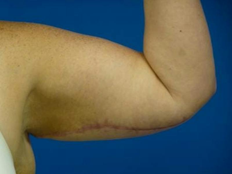 Brachioplasty Before & After Gallery - Patient 160325 - Image 6