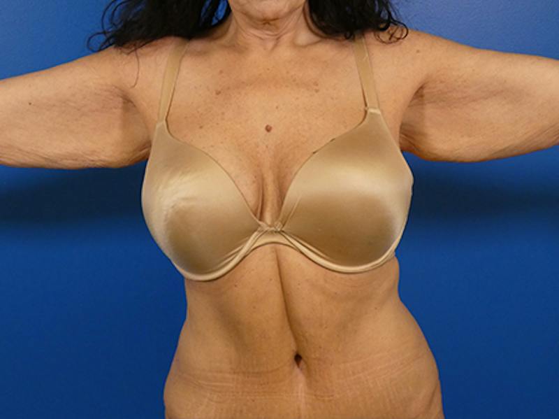 Brachioplasty Before & After Gallery - Patient 611508 - Image 1