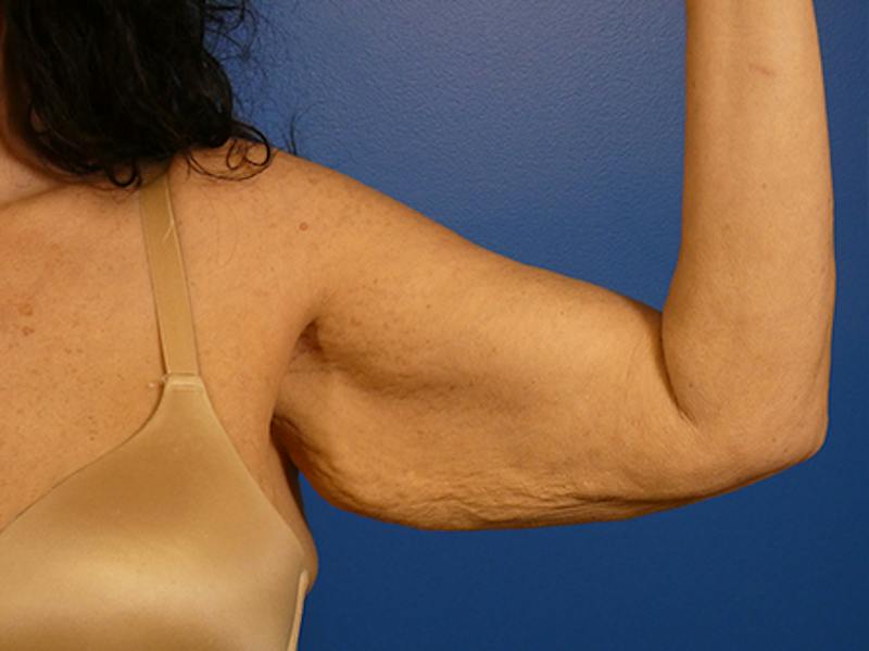 Brachioplasty Before & After Gallery - Patient 611508 - Image 3