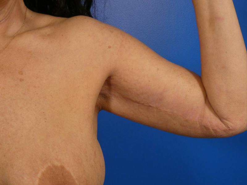 Brachioplasty Before & After Gallery - Patient 611508 - Image 4