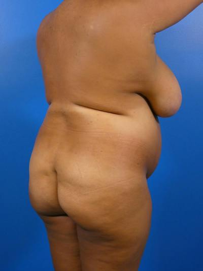 Brazilian Butt Lift Before & After Gallery - Patient 497598 - Image 1