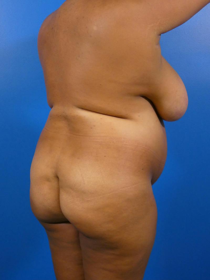 Brazilian Butt Lift Before & After Gallery - Patient 497598 - Image 1
