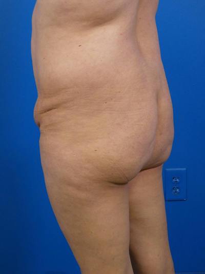 Brazilian Butt Lift Before & After Gallery - Patient 125459 - Image 1