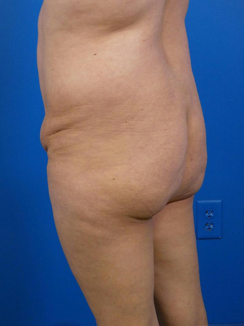 Brazilian Butt Lift Before & After Gallery - Patient 125459 - Image 1