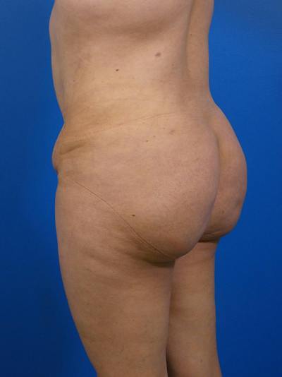 Brazilian Butt Lift Before & After Gallery - Patient 125459 - Image 2