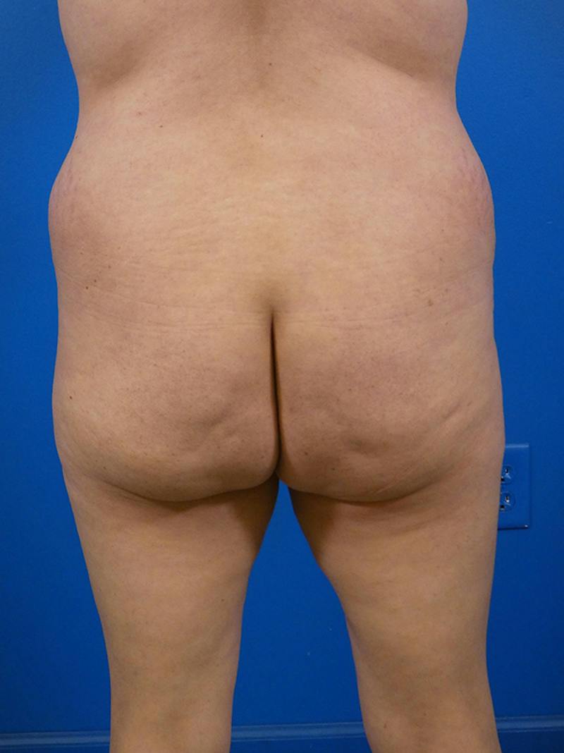 Brazilian Butt Lift Before & After Gallery - Patient 125459 - Image 3