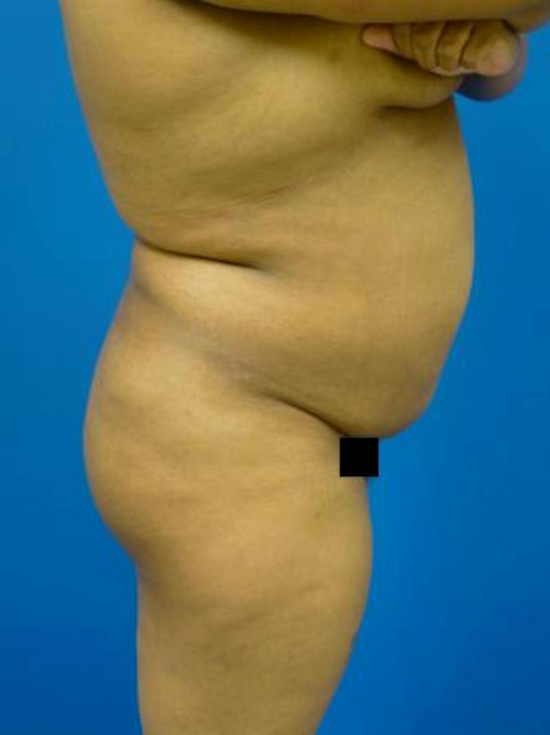 Brazilian Butt Lift Before & After Gallery - Patient 398815 - Image 1