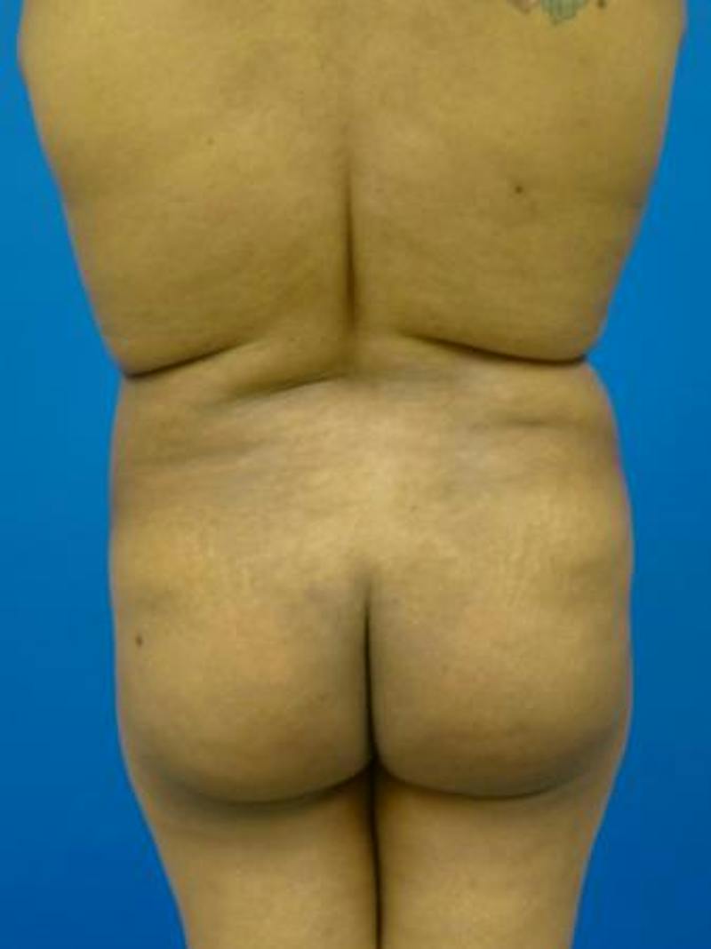 Brazilian Butt Lift Before & After Gallery - Patient 398815 - Image 3