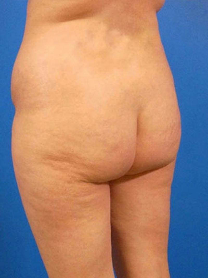 Brazilian Butt Lift Before & After Gallery - Patient 215201 - Image 1