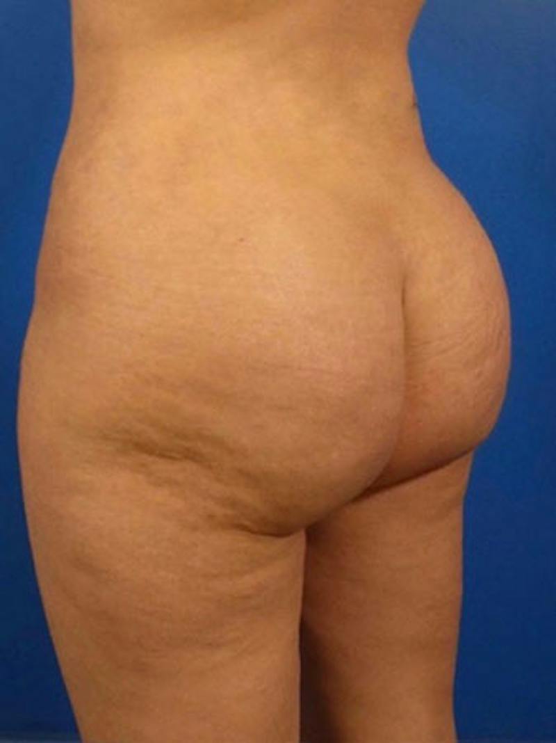 Brazilian Butt Lift Before & After Gallery - Patient 215201 - Image 2