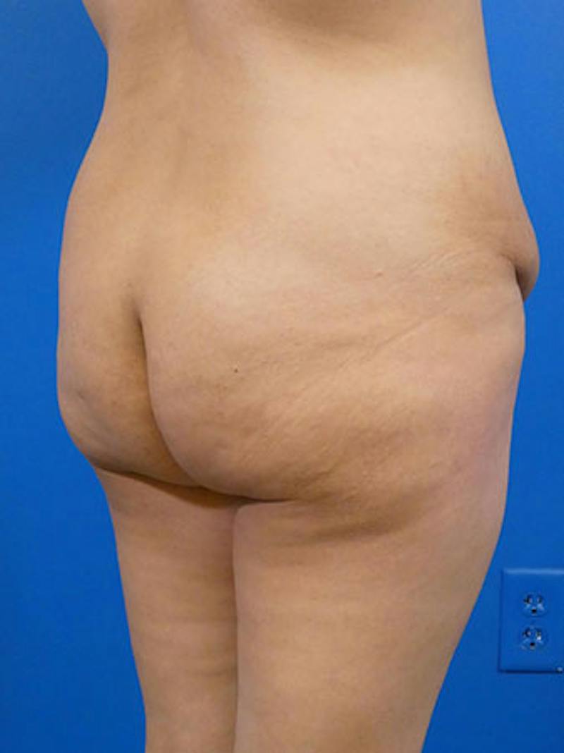 Brazilian Butt Lift Before & After Gallery - Patient 283702 - Image 1