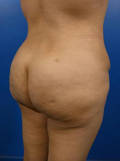 Brazilian Butt Lift Before & After Gallery - Patient 283702 - Image 2