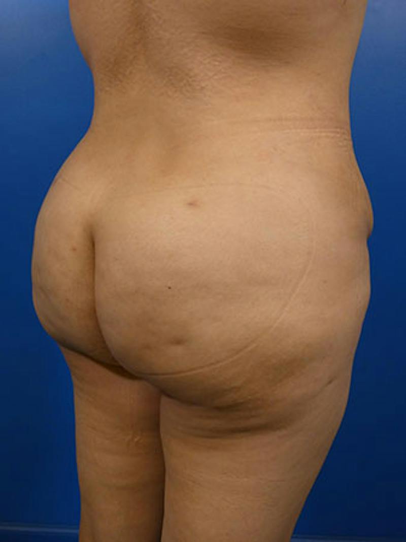Brazilian Butt Lift Before & After Gallery - Patient 283702 - Image 2