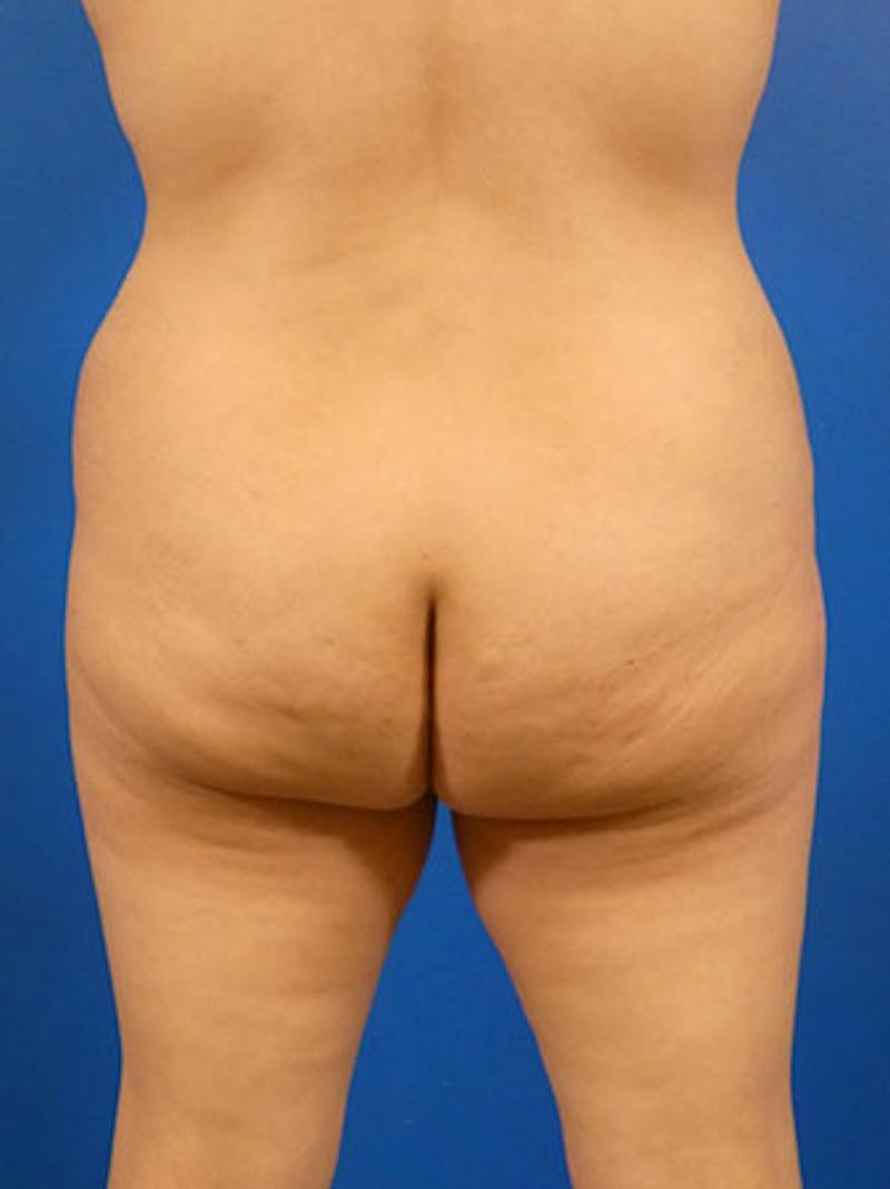 Brazilian Butt Lift Before & After Gallery - Patient 283702 - Image 3