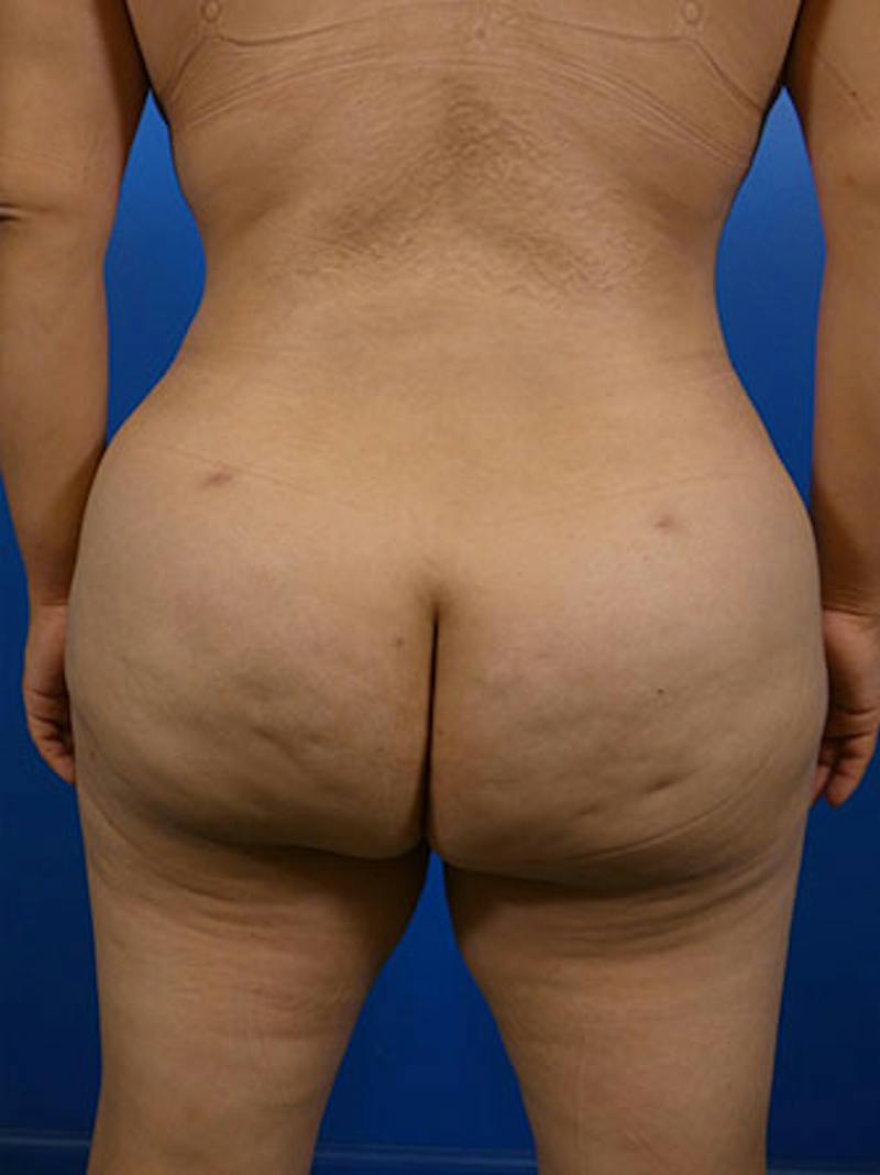 Brazilian Butt Lift Before & After Gallery - Patient 283702 - Image 4