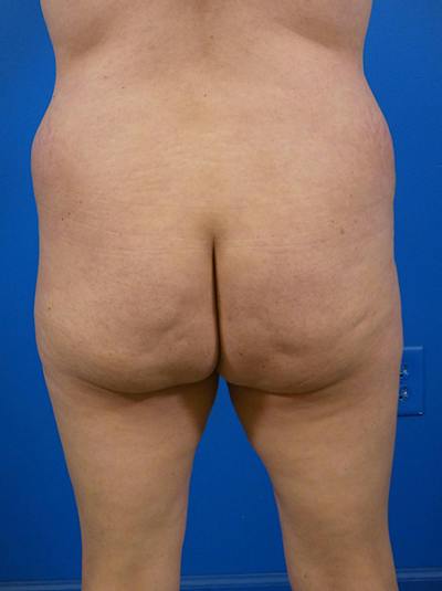 Brazilian Butt Lift Before & After Gallery - Patient 139011 - Image 1
