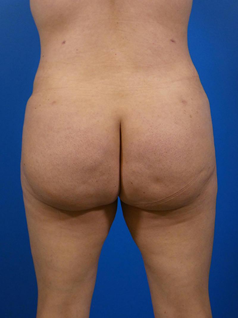 Brazilian Butt Lift Before & After Gallery - Patient 139011 - Image 2