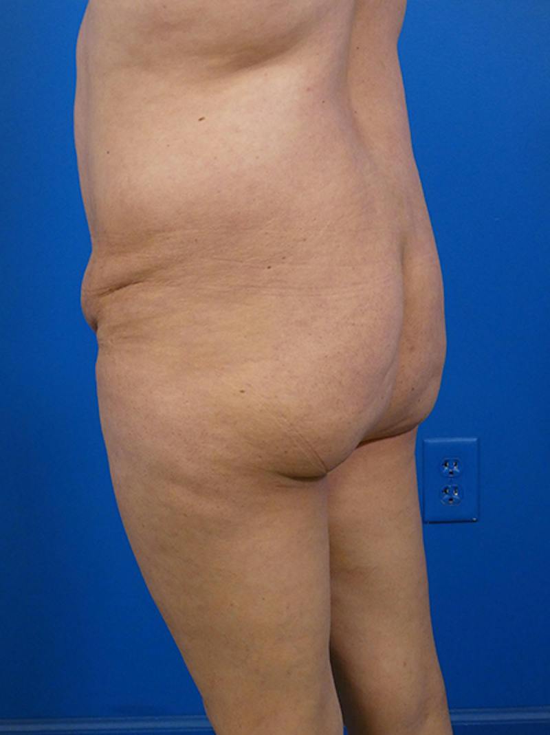 Brazilian Butt Lift Before & After Gallery - Patient 139011 - Image 3