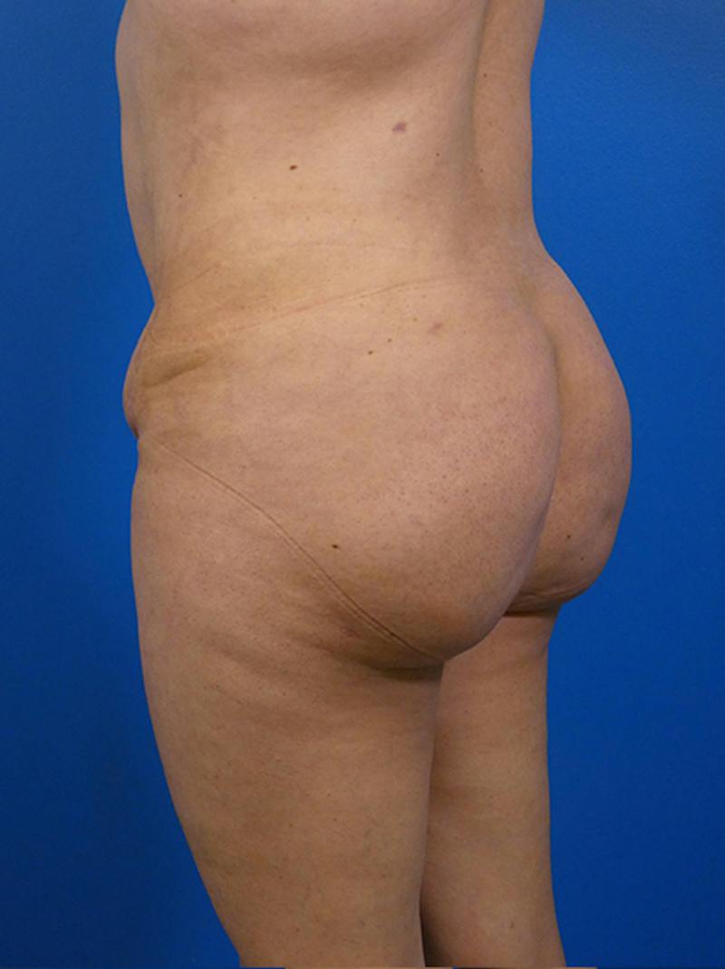 Brazilian Butt Lift Before & After Gallery - Patient 139011 - Image 4