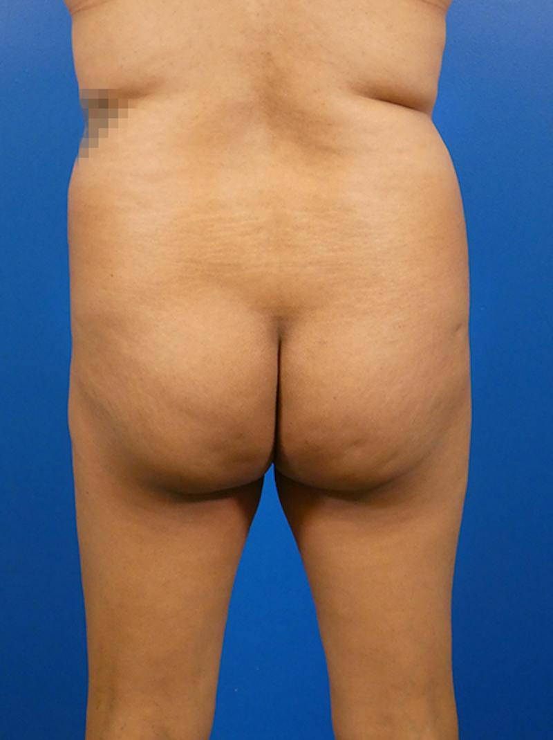 Brazilian Butt Lift Before & After Gallery - Patient 890234 - Image 1